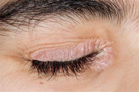 What Causes Dry Crusty Eyes